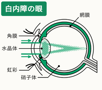 目の病気の早期発見・治療のための情報を配信します。 眼疾患早期発見コンソーシアム 白内障