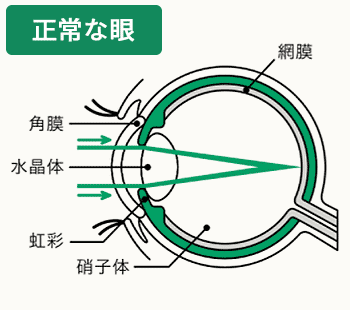 目の病気の早期発見・治療のための情報を配信します。 眼疾患早期発見コンソーシアム 白内障