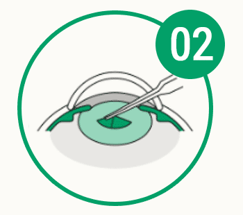 目の病気の早期発見・治療のための情報を配信します。 眼疾患早期発見コンソーシアム 白内障