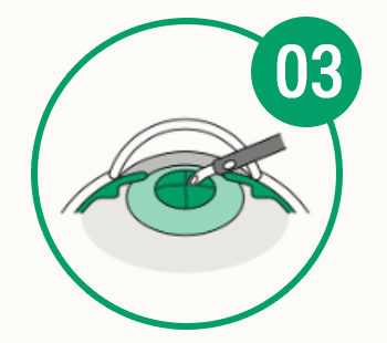 目の病気の早期発見・治療のための情報を配信します。 眼疾患早期発見コンソーシアム 白内障